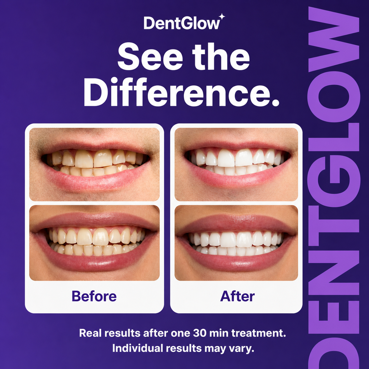DentGlow™ Purple Whitening Strips – Peroxide-Free, No Sensitivity